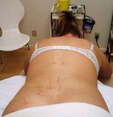 Krops akupunktur